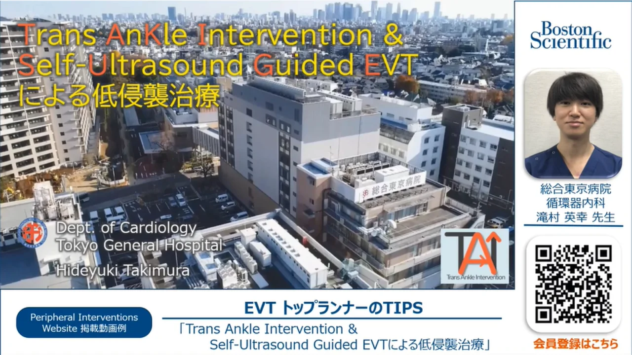 末梢血管インターベンション | 医療従事者の方 | ボストン