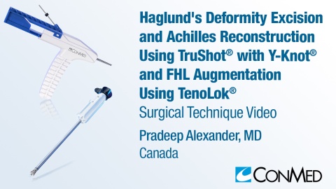 Dr. Alexander - Haglund's Deformity Excision and Achilles Reconstruction Using TruShot® with Y-Knot® and FHL Augmentation Using TenoLok®