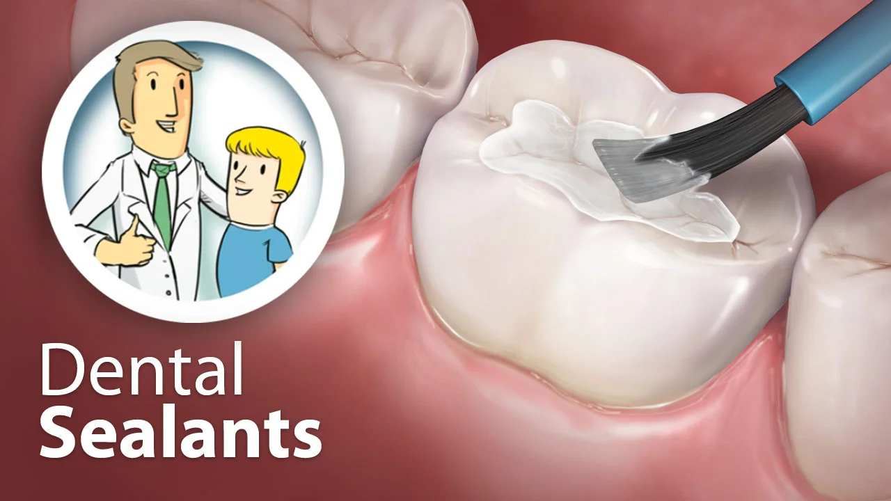 dental sealants