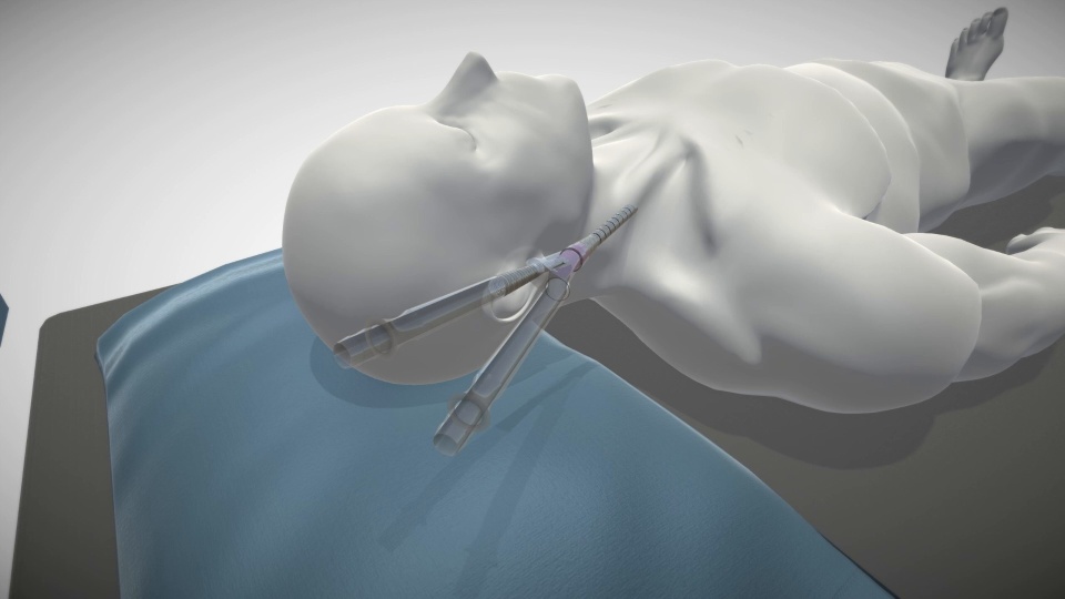 TandemLung VV Cannulation Animation video thumbnail