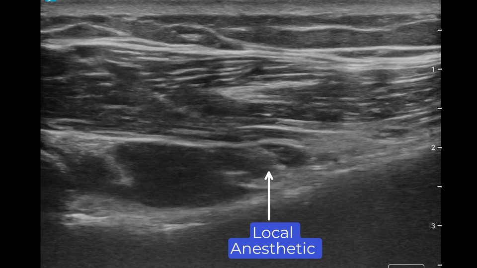 Axillary Nerve Block | CSurgeries