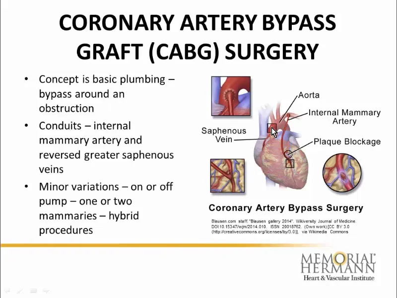 coronary artery disease treatment