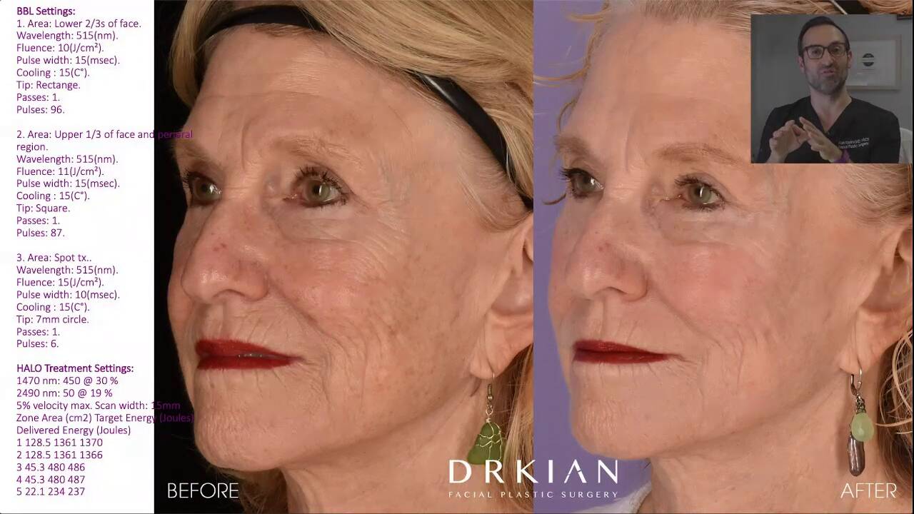 Thumbnail for A Corrective Solution for Aging Skin with HALO