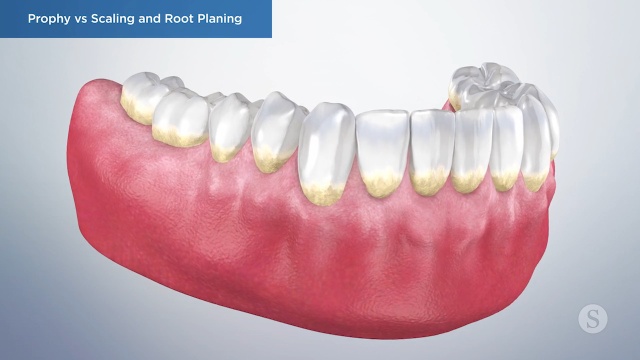 Deep Cleaning - Brushwell Dental & Implants