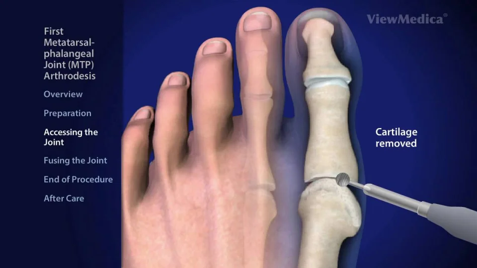 Az ujjak interphalangealis ízületeinek ízületi gyulladása