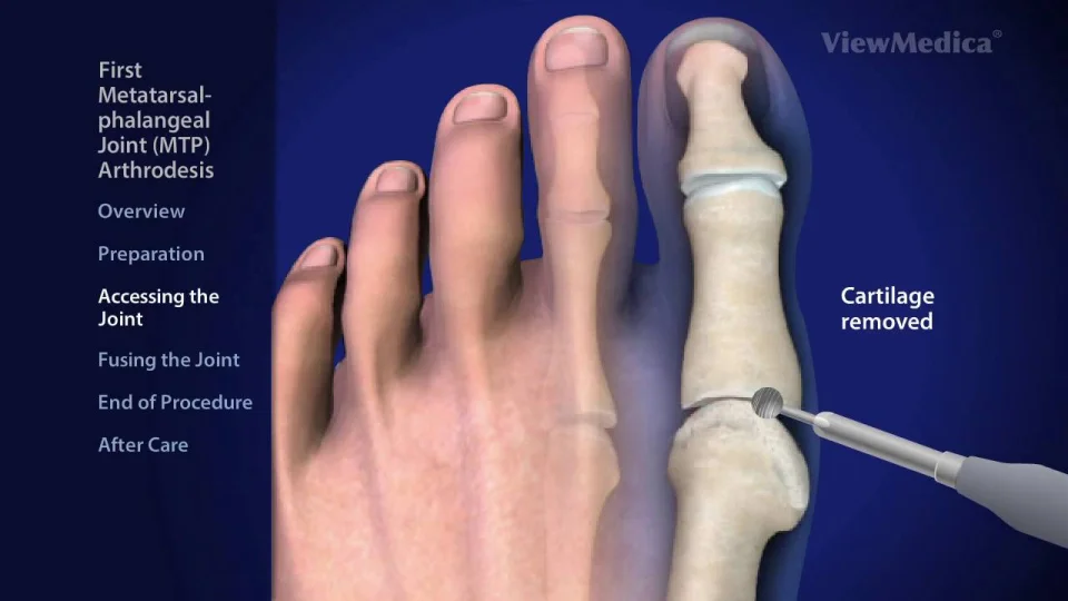 first metatarsophalangeal joint osteoarthritis)