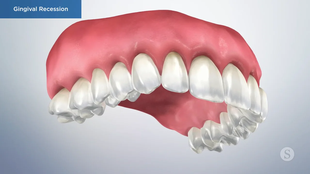 What is a Gingivectomy? Procedure & Recovery