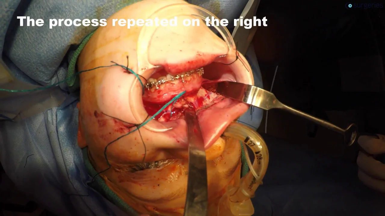 LeFort I Osteotomy and Advancement in Patient with Maxillary Hypoplasia |  CSurgeries