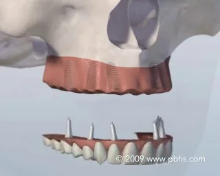 Teeth-in-an-hour Nashville TN | Dental Implants | Dickson TN