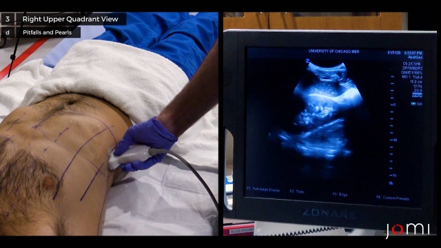 North American Rescue - #EFAST with @nardoctor Let's review the E-FAST  exam. This quick ultrasound exam allows us to evaluate for intrabdominal  hemorrhage, cardiac tamponade, hemothorax and pneumothorax. The chart above  from @