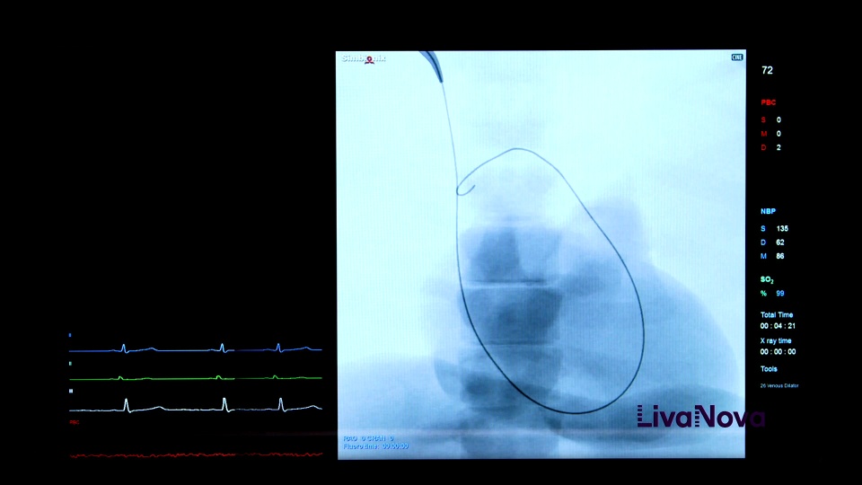 ProtekDuo Insertion video thumbnail