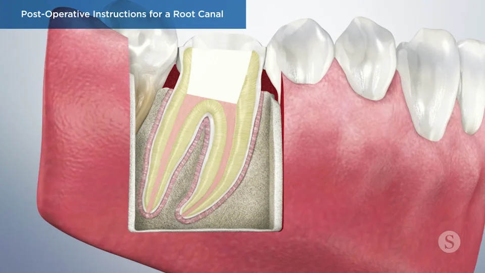 Dental Filling Pre-Operative Instructions