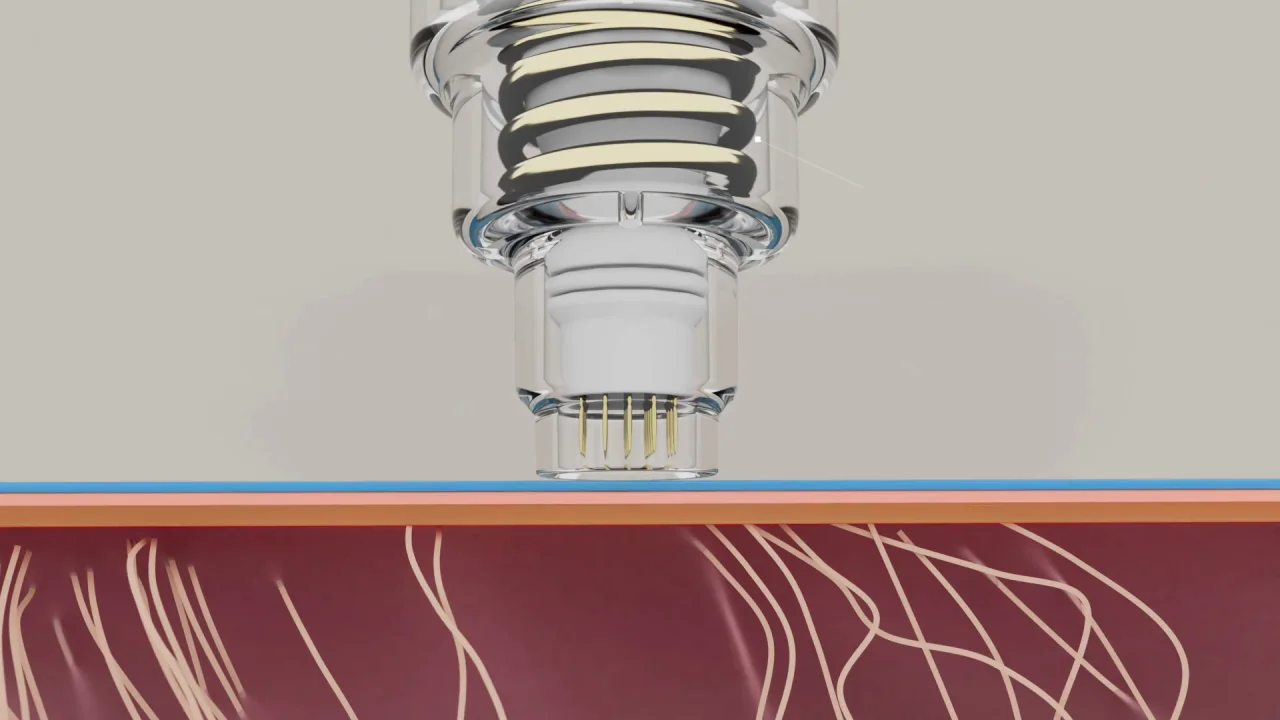 Microneedling Machine | Potenza™ | Cynosure Microneedling Machine | Potenza™ | Cynosure
