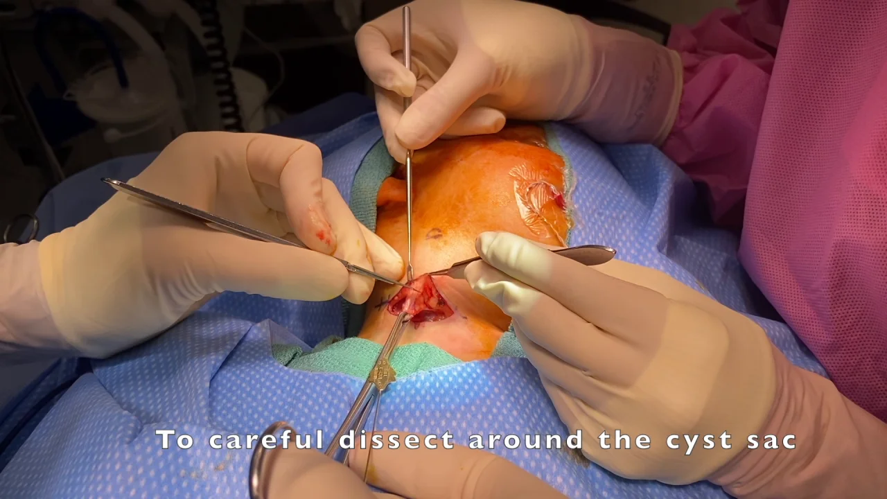 first branchial cleft cyst