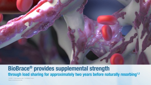BioBrace® Reinforced Implant - Product Video