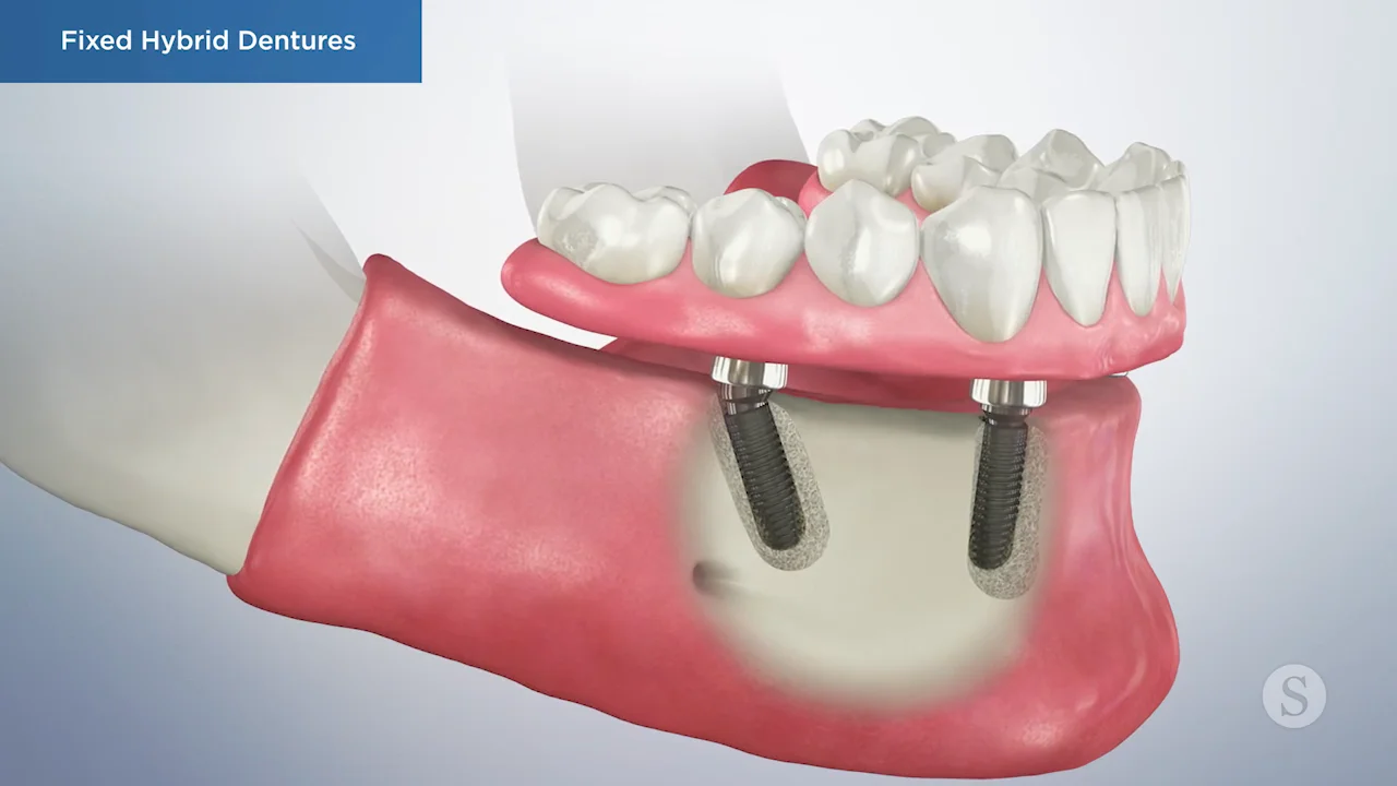 SP061 Fixed Hybrid Dentures