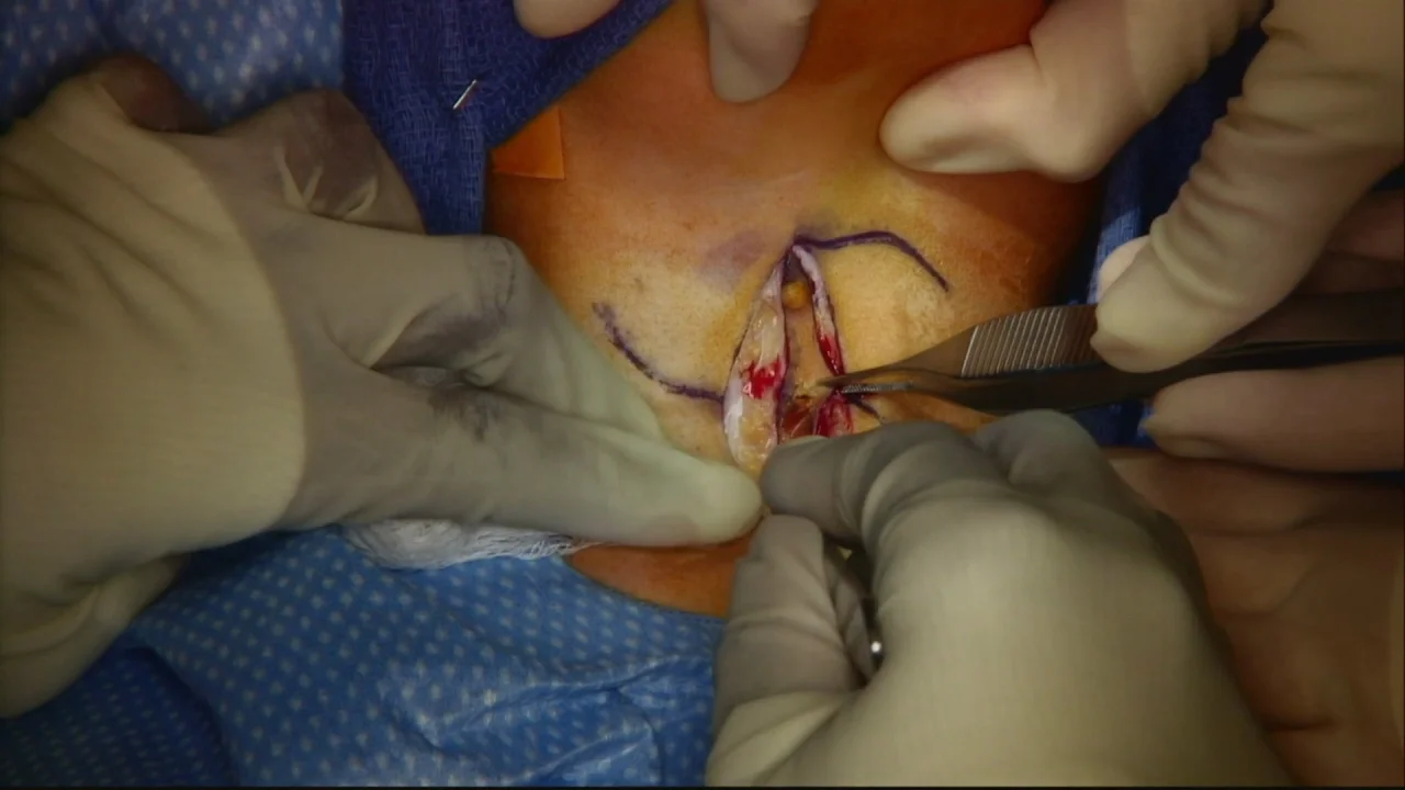 Midline Cervical Cleft Excision of Fibrous Cord – Z Plasty Closure