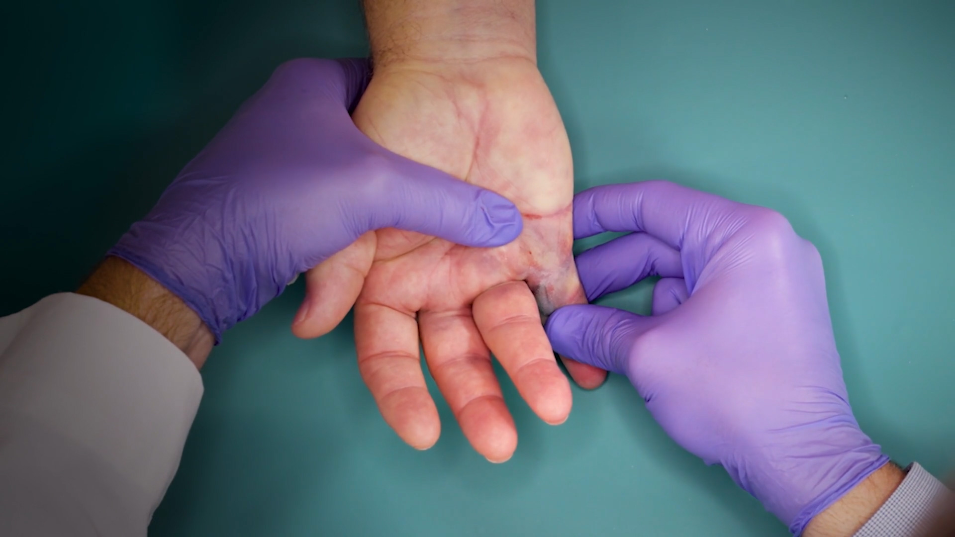 Fifth finger 30° MP joint and 45° PIP joint contractures procedure video thumbnail