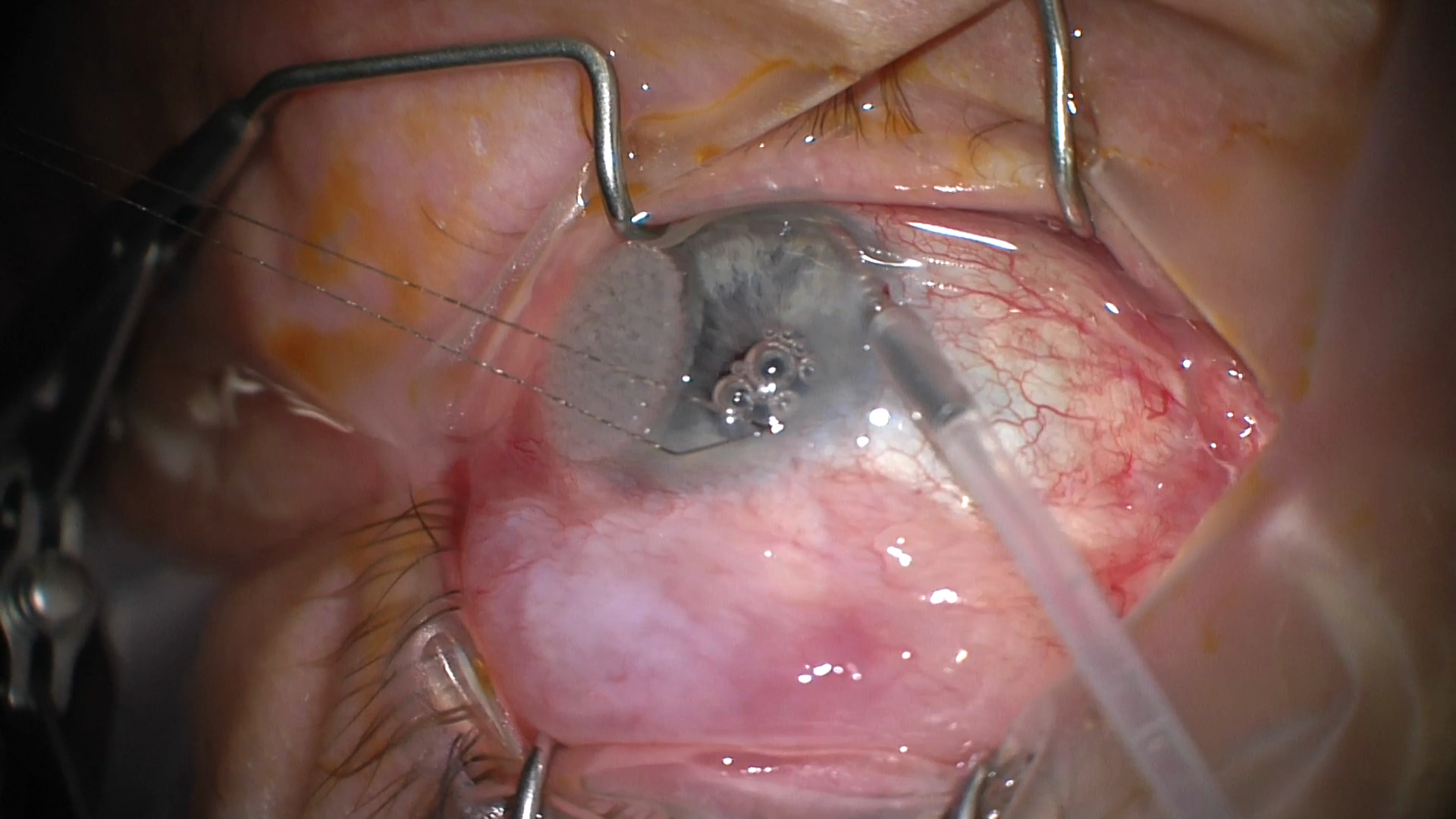 Bleb Needling in Trabeculectomy Revision – CSurgeries
