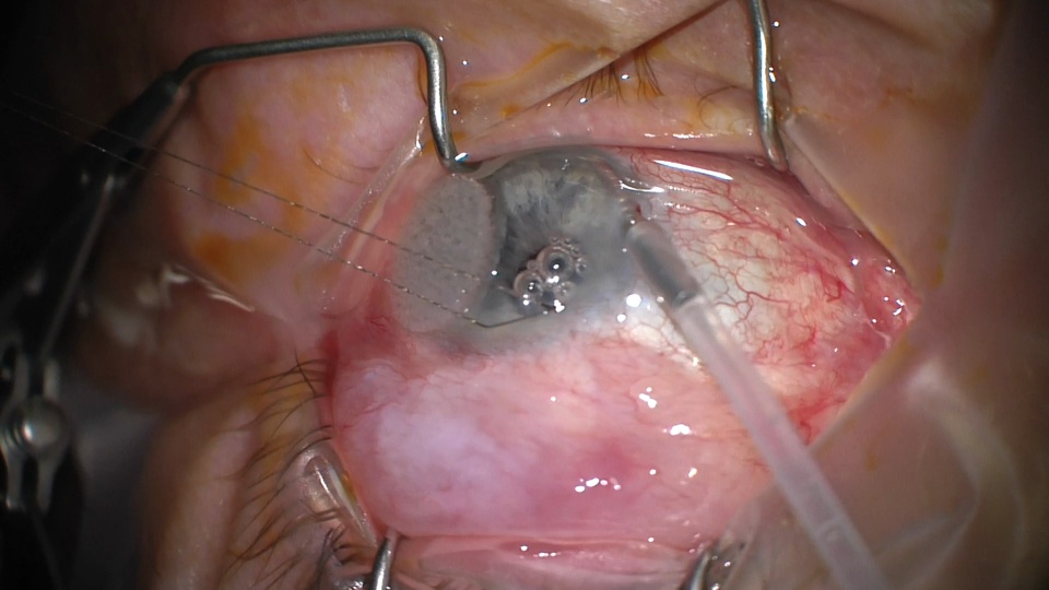 Bleb Needling in Trabeculectomy Revision | CSurgeries