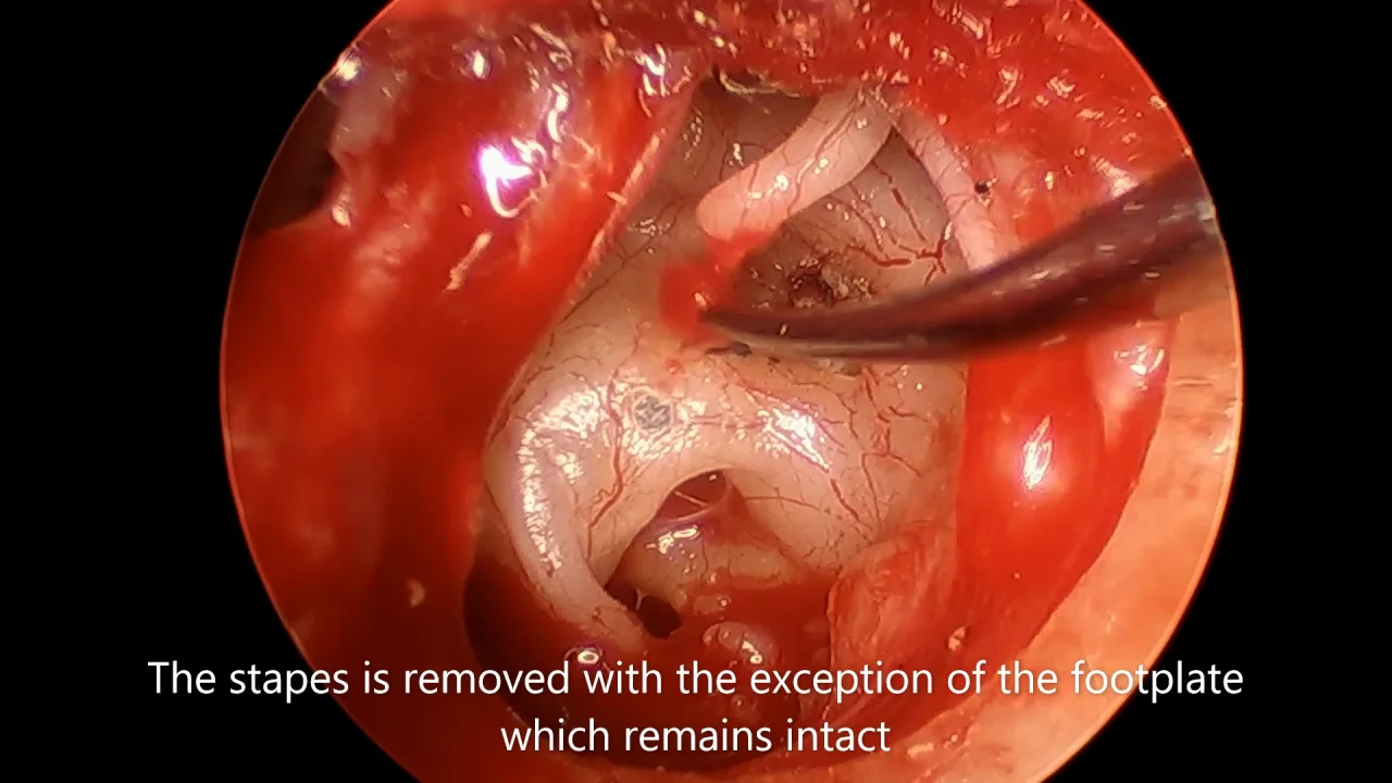 Complications of stapes surgry