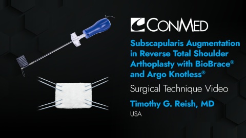 Dr. Reish - Subscapularis Augmentation in Reverse TSA with BioBrace® and Argo Knotless®