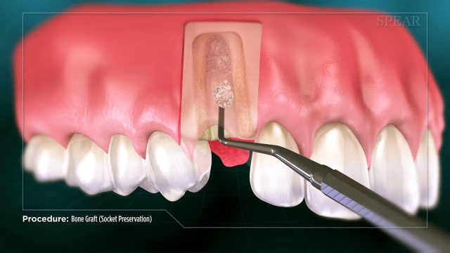 Bone Grafting Midtown Nyc Dental Bone Graft For Dental Implants