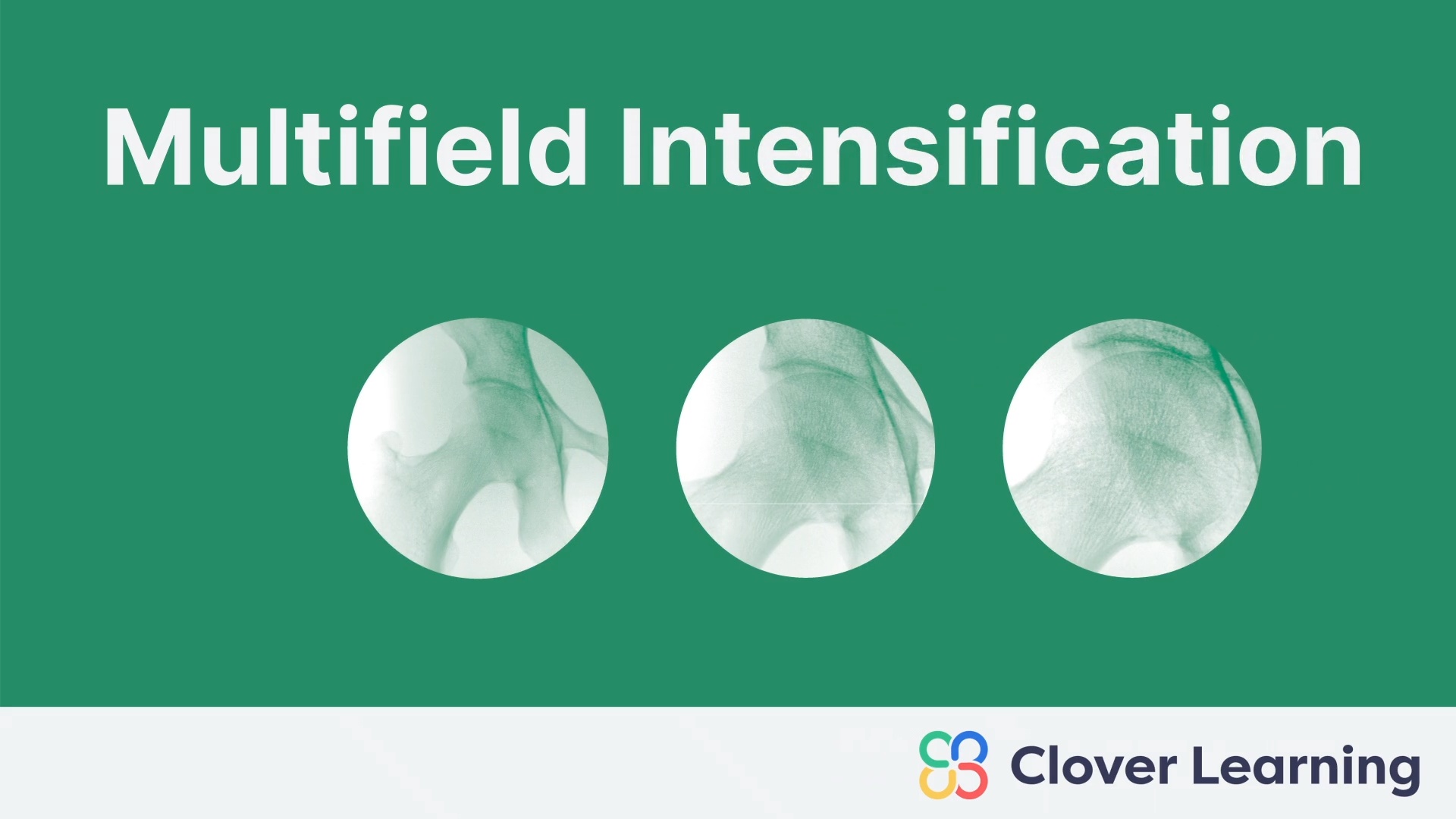 Multifield Intensification | Video Lesson | Clover Learning