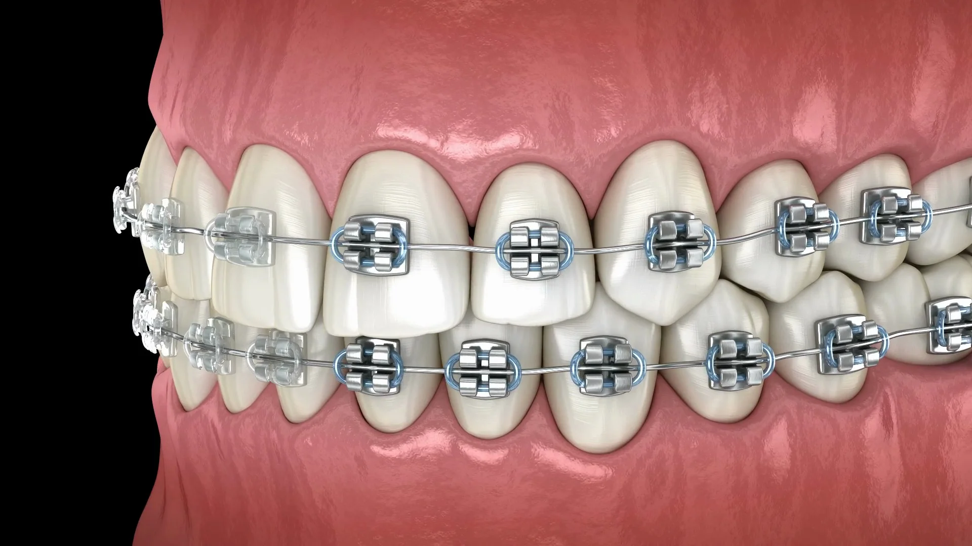 Clear Braces for Teens: The Pros and Cons of Ceramic Braces, Lower  Mainland BC