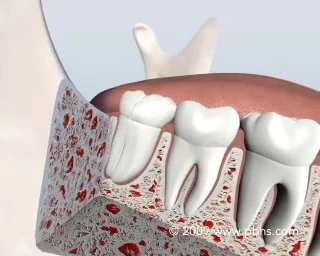 Third molar store teeth