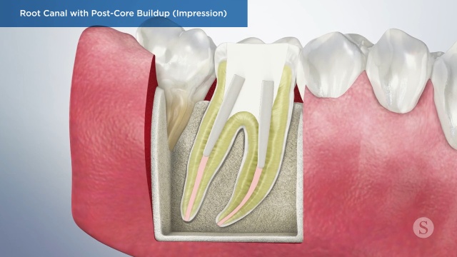 Root Canal Treatment