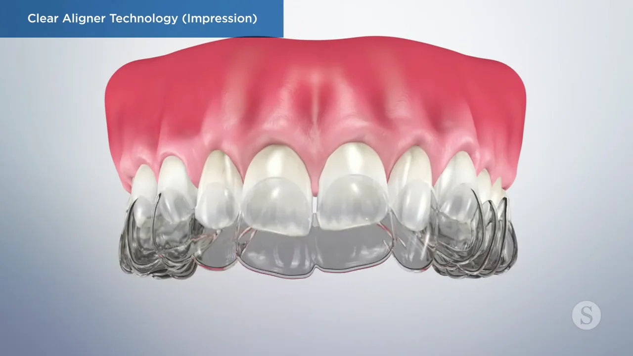 Invisalign & Clear Aligners