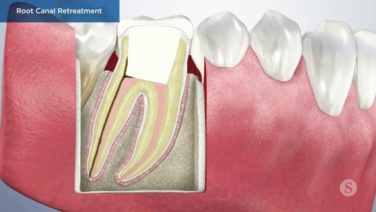 Cracked Teeth Solutions - Modern Endodontics of Buckhead