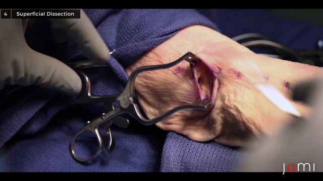 Cubital tunnel syndrome surgery, cubital tunnel release surgery - Medicover