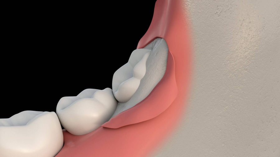<p>Third molars are commonly referred to as wisdom teeth. They are usually the last teeth to develop and are located in the back of your mouth, behind your second molars. Their development is usually completed between the middle teenage years and early twenties, a time traditionally associated with the onset of maturity and the attainment of wisdom.</p>
