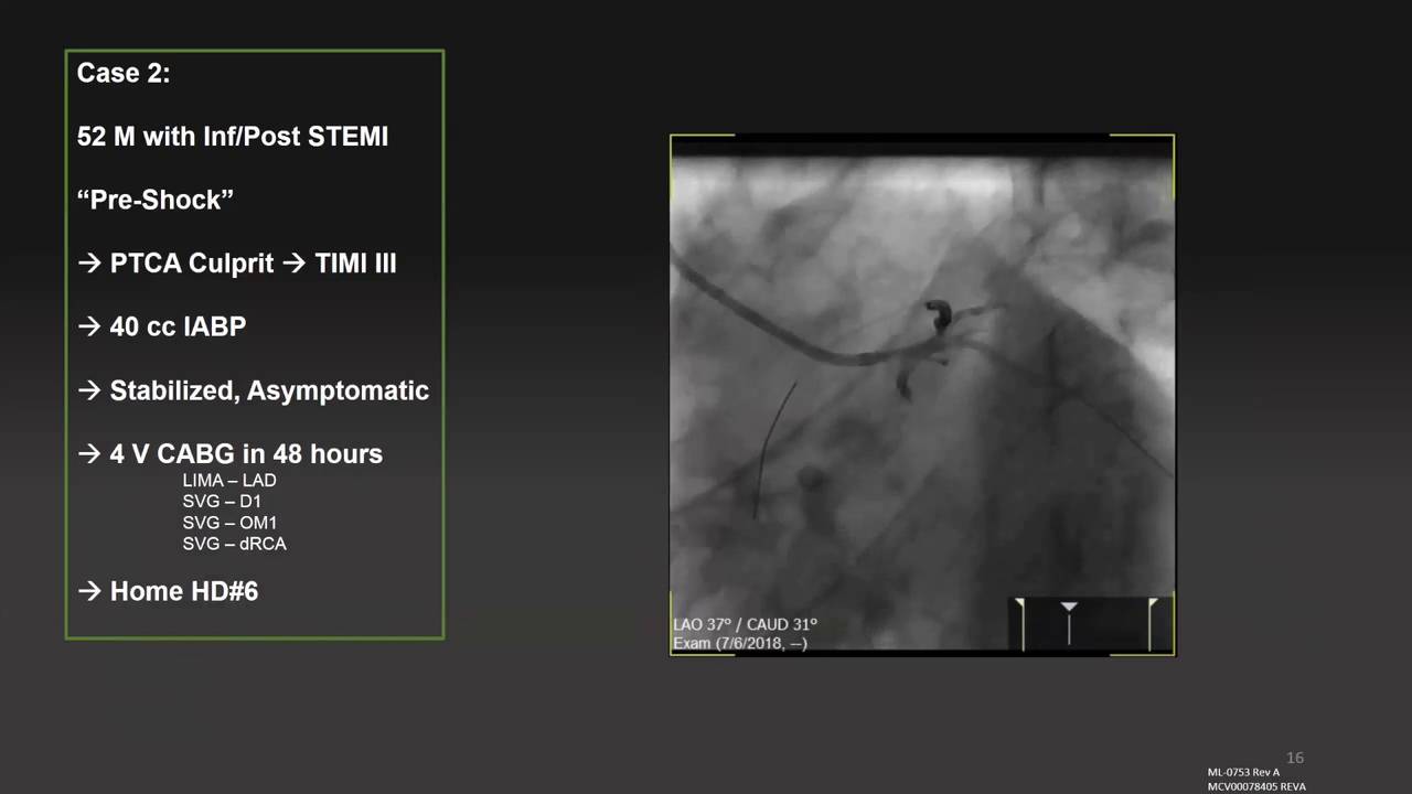 Download Cabg Coronary Artery Bypass Graft