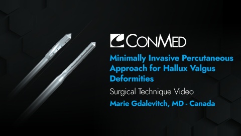 Dr. Gdalevitch - Minimally Invasive Percutaneous Approach for Hallux Valgus Deformities