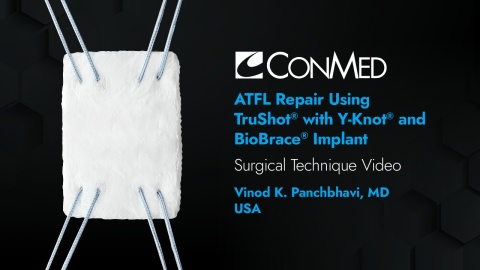 Dr. Panchbhavi - ATFL Repair Utilizing TruShot® with Y-Knot® and BioBrace® Implant