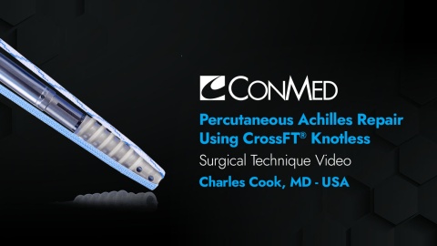 Dr. Cook - Percutaneous Achilles Repair Using the CrossFT® Knotless