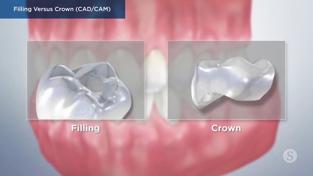 Dental Filling vs. Crown: Which is Right For Me?