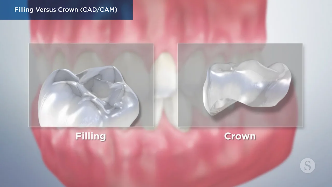 Ill Fitting Crown  Crown Pointe Dentistry