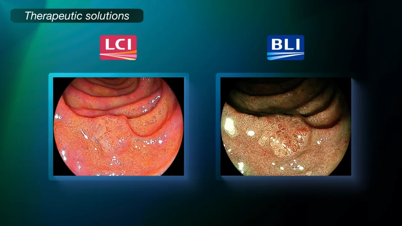 Diagnostic Gastro Video Imaging System | Fujifilim ELUXEO