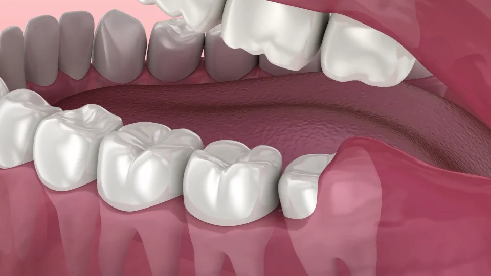 wisdom teeth before and after