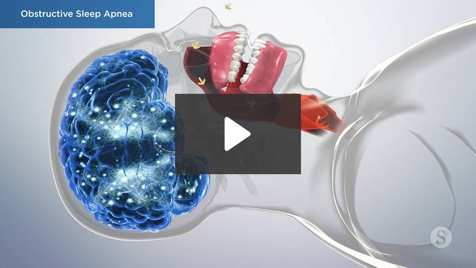obstructive sleep apnea
