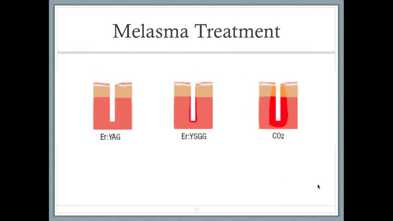 Thumbnail for How to Effectively Manage Melasma