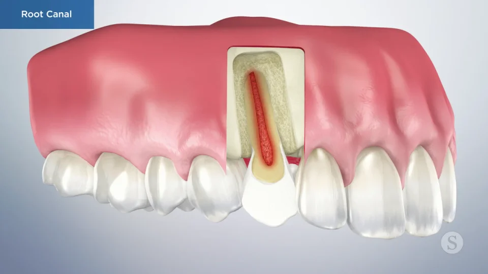 front tooth root canal