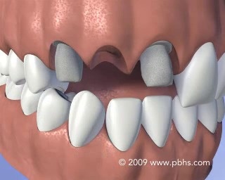 Dental Bonding in Las Vegas  Tooth Bonding in Spring Valley