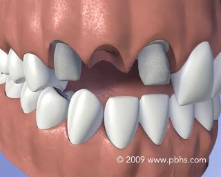 Invisalign Attachments  Orthodontist Gaithersburg MD Invisalign