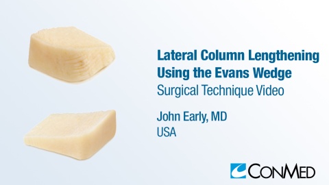Dr. Early - Lateral Column Lengthening Using the Evans Wedge