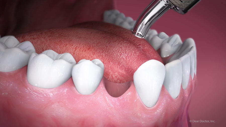 ADA video discussing a Tooth Extraction procedure